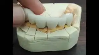 crown and bridge work at smile dental clinic