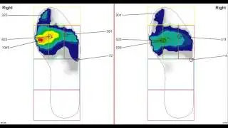 Analysing pedalling stability with foot pressure mapping