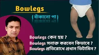 Bowlegs ( বাঁকানো পা ) | Bowlegs কি এবং কেন হয় ? | Bowlegs প্রতিরোধে করণীয় কি ?