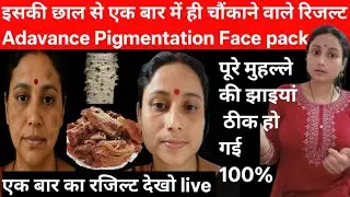 एक बार में ही चौंकाने वाला रिजल्ट Semal Advance Pigmentation Removel Face pack se Dark झाइयां खत्म