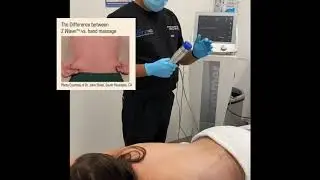 What is Z wave treatment? Benefits of having Z wave treatment after lipo, coolsculpting.