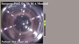 LenSx Laser Cataract @09.05.2024 Prof. Dr. Sk. M A Mannaf Sir 09.05.2024