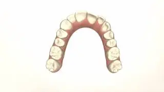 Patient 126 Invisalign movie