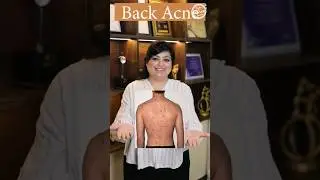 How to get rid of Back Acne? | Back Acne Treatment | Lacne Body Spray #shorts