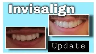 Invisalign Before and After Update