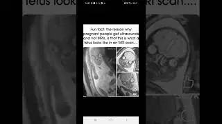 MRI baby scan picture #babyscan #scarybaby