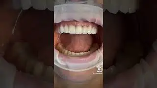 Gum laser!? #cosmeticdentistry #dentist #veneers #fyp #trending #smilemakeover #cosmeticdentist