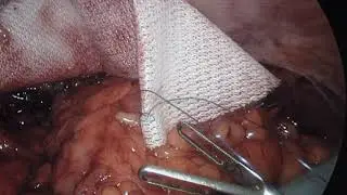 IPOM Laparoscopic Incisional Hernia repair using Parietex Dual Mesh