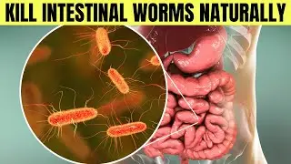 8 Foods That Kill Intestinal Worms Naturally | Get Rid Of Intestinal Worms