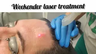 Sciton Micro Resurfacing Laser Peel (Weekender)