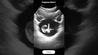 Baby Moving (Week 5) | Real Ultrasound Moment 😘  #Shorts #ultrasound  #pregnancyjourney