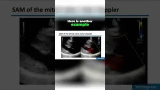 Systolic Anterior Motion (SAM) & LVOT Obstruction