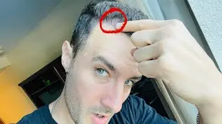 The Most Painful Part of Hair Transplant NO ONE Talks About