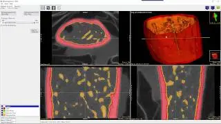 Analyze 14.0 - BMA: Bone Microarchitecture Analysis