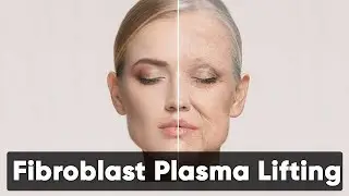 Fibroblast Plasma Lifting | Dr. Hassan Dawood | Health Matters