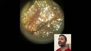 435 - Удаление закупоренной ушной серы из щелевидных ушных каналов с помощью WAXscope&reg;