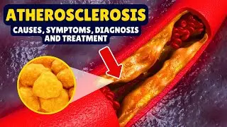 What is Atherosclerosis? Causes, Signs and Symptoms, Diagnosis & Treatment