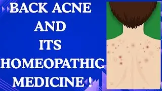 BACK ACNE || CHEST ACNE || BEST HOMEPATHIC MEDICINE FOR BACK ACNE !