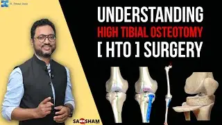 Understanding High Tibial Osteotomy  HTO Surgery@DrdebashishChanda #orthopaedicsurgery