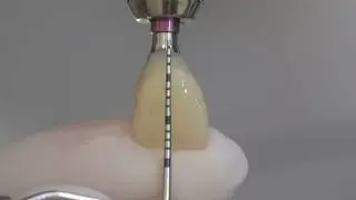 Provisorio PMMA Straumann BLX RB sobre Variobase gh 2.5mm
