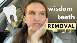 i got my wisdom teeth out