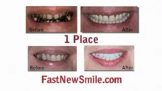 Fast New Smile by Dental Solutions