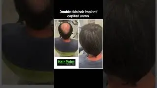 #hairpointcentercatania #hair Double skin hair impianti capillari uomo