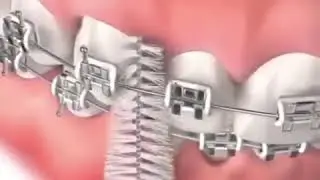 How to use interdental brushes with braces