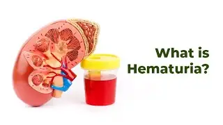 Transient Hematuria ; Definition, Causes, Evaluation, Management