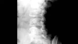 Aneurysmal Bone Cyst L3 Pedicle