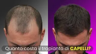 Quanto costa il trapianto di Capelli? Lo spiega il Dottor Skerdi Faria