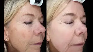 Huidverbetering met de Cosmopeel Forte van Dermaceutic