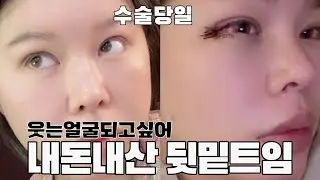 내돈내산 눈 뒷밑트임 성형수술 당일 후기 - 마취깨고