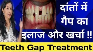 दांतों में गैप का इलाज और खर्चा |Teeth Gap Treatment Cost |Gap In Front Teeth Treatment |Dant me gap