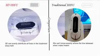 3DHIFU VS Normal HIFU