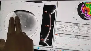 Corneal densitometry pentacam explained 
