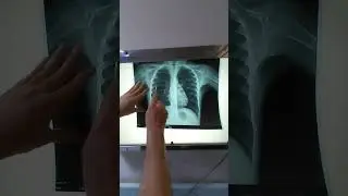How we can read chest X ray easily