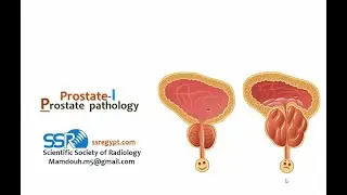 9- Imaging of the prostate TRUS ,CT, MRI (I) - Prof  Mamdouh Mahfouz