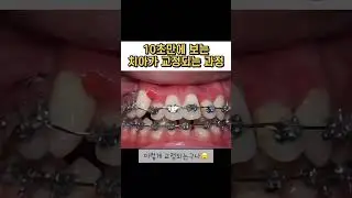 10초만에 보는 치아 교정 과정 #shorts