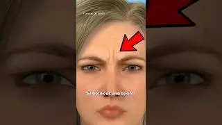 Esta es la DIFERENCIA entre B&Oacute;TOX y &Aacute;CIDO HIALUR&Oacute;NICO