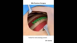 How do ribs fractures heal? #paramedicaleducation #science  #bonefracture #fracturemanagement