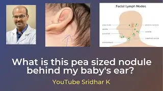 What is this pea like swelling behind my baby&rsquo;s ears?  Sridhar K #lymphnode #nodule #babyswelling
