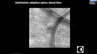 Adaptive optics imaging of optic neuropathies