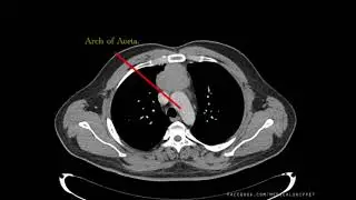 CT Thorax - How to Read
