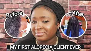 My First Alopecia Client - Unbelievable Hair Transformation - Did it Work?