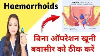 Hemorrhoids | Homeopathic Treatment for Bleeding Piles | बवासीर का इलाज़ |