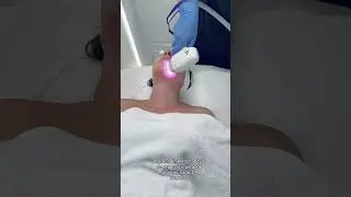 Depilaci&oacute;n l&aacute;ser facial femenina #depilaciondefinitiva #depilacionlaserfacial #depilacionfemenina