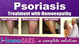 Psoriasis | Cause, Types, Symptoms and homeopathic treatment of Psoriasis. Reverse Psoriasis.
