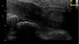 Median nerve, post carpal tunnel operation, pronounced residual compression. Nerve ultrasound.