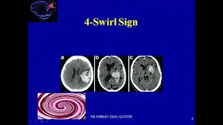Brain Talk:11 predictors for hematoma expansion on CT